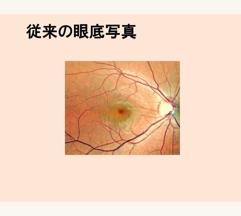 超広角眼底撮影装置